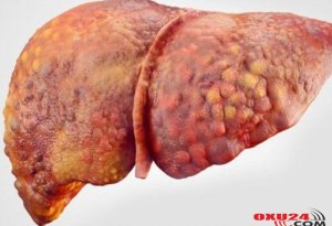 Sirrozu təkcə hepatit yaratmır, başqa səbəblər də çoxdur – Müayinə barədə həkim məsləhəti