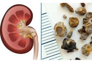 Böyrək daşı xəstəliyinin riskini 45% azaldan SADƏ MEYVƏ