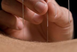 Akupunktura nədir?