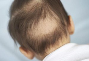 Uşaqlarda saç tökülməsinin əlamətləri - Pediatr açıqladı