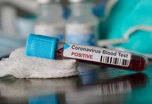 TƏBİB rəsmisindən koronavirusdan ölüm sayı ilə bağlı - Açıqlama