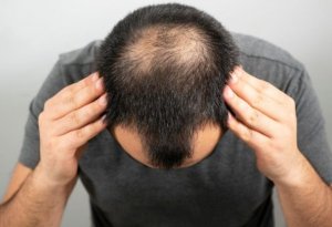 Saç tökülməsinin qarşısını alan 5 ƏSAS QİDA