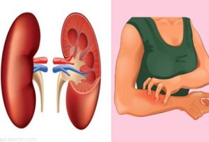 Bu işarələrə DİQQƏT: Böyrəklərinizdə xəstəlik olduğunu bildirən, ağlınıza gəlməyən 8 əlamət