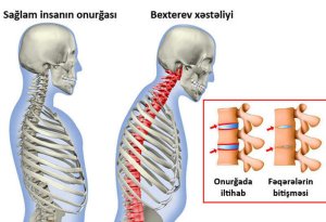 Bexterev xəstəliyi. Hərəkətsiz onurğa