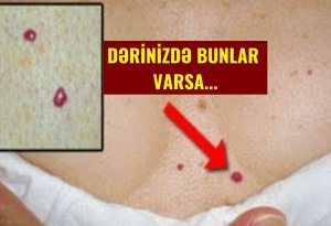 DİQQƏT!!! sizdə bu 10 əlamətdən biri varsa, Ürəyiniz düz işləmir (VİDEO)