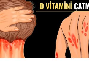 D vitamini çatışmazlığının vacib əlamətləri BUNLARDIR
