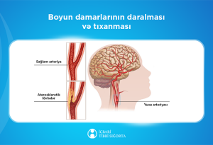 Bu müalicə də icbari tibbi sığortaya daxildir