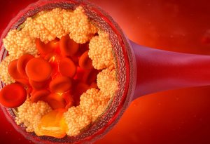 Dietoloq xolesterolu aşağı salan qidaları açıqladı