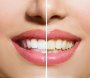 Dişlərin saralmasının əsas 9 səbəbi