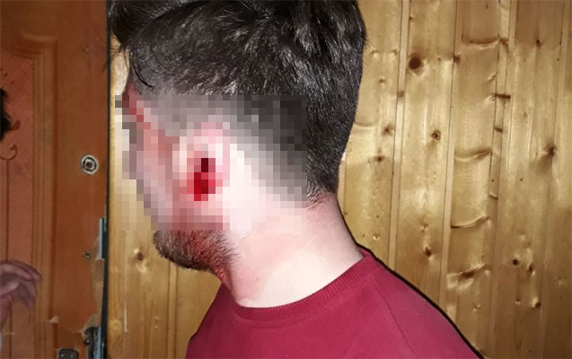 Bakıda ŞOK! Polis sürücünün qulağını qopardı - FOTO