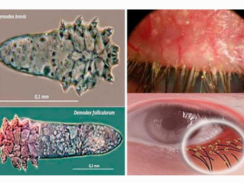 Kirpik gənəsi xəstəliyi nədir? - Xəbərdar olun ki, qorunasınız!