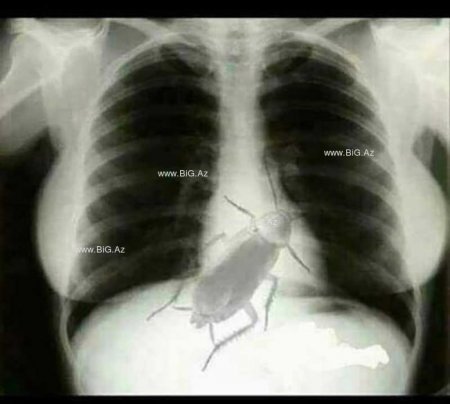 Azərbaycanlı həkim xəstəyə \\\"sinəndə böcək var\\\" deyib xaricə göndərdi, BİABIR OLDU - FOTOFAKT
