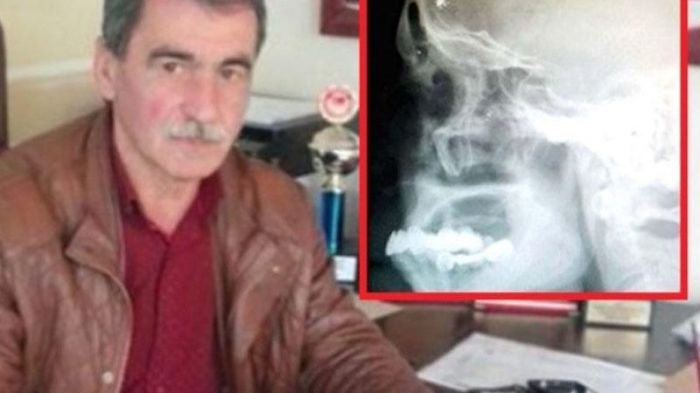 Başı ağrıyan kişini rentgenə saldılar - Həqiqəti görən həkim mat qaldı