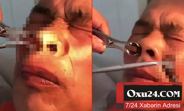 Burnundan çıxan canlı həkimləri şoka saldı — FOTO