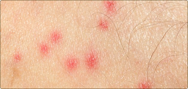 Bədəninizdə qırmızı NÖQTƏLƏR VARSA, bu yazını mütləq OXUYUN