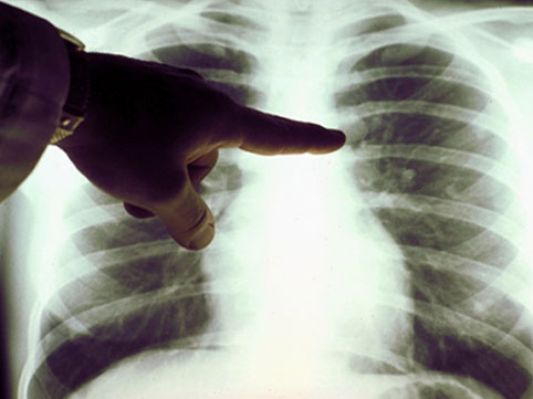 Ağciyər xərçənginin 7 əlaməti - DİQQƏT!