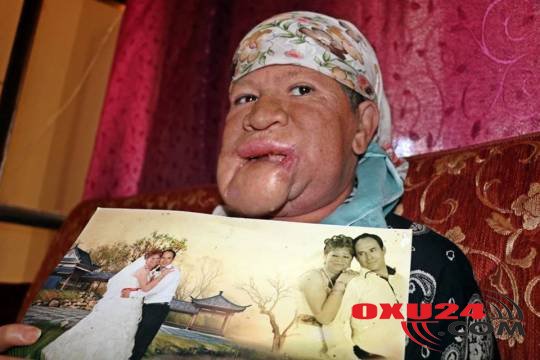 Çənəsindən çıxan sızanağa əhəmiyyət verməyən qadının həyatı alt-üst oldu - FOTOLAR