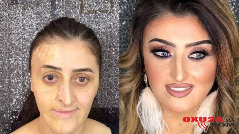 Azərbaycanda üzü tamamilə yanan qızın İNANILMAZ DƏYİŞİMİ