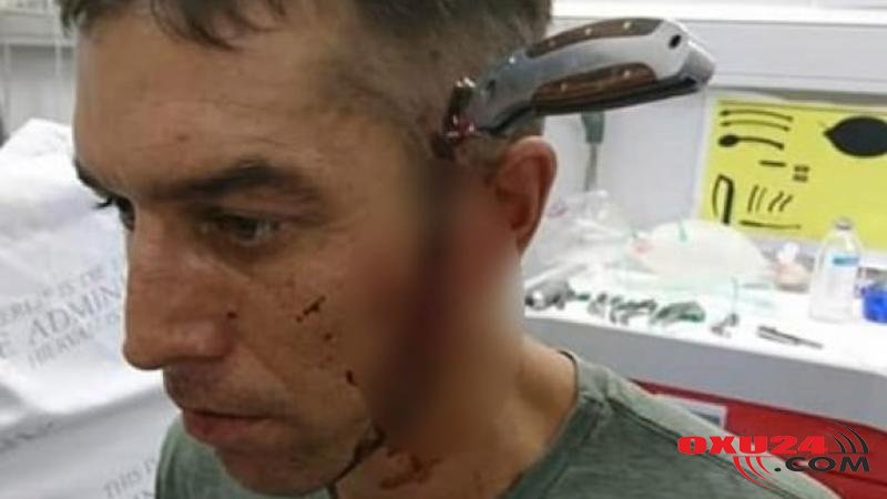 Başına 15 santimetrlik bıçaq saplanan kişi hamını DƏHŞƏTƏ GƏTİRDİ: həkimə piyada getdi və... - FOTO Cinayət dünyası