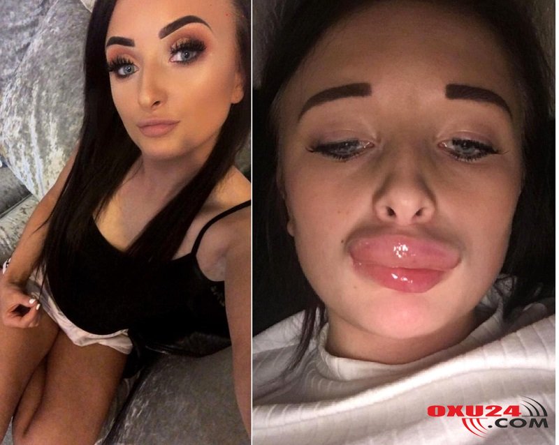 Dodağına silikon vurdu, belə oldu - VİDEO