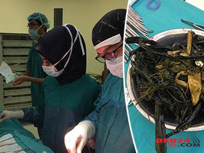 Uşağın mədəsindən çıxanlar həkimləri ŞOKA SALDI