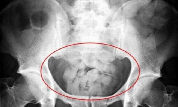 Azərbaycanda ŞOK olay: Gömrük işçiləri qadının cinsiyyət orqanından briliant çıxardı