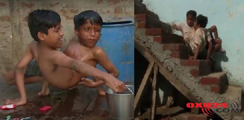 Bədənləri birləşik,başları ayrı: Siyam əkizləri necə doğulur?+VİDEO