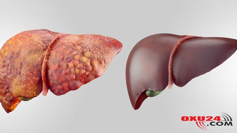 Qaraciyər çatışmazlığına səbəb olan AMİLLƏR