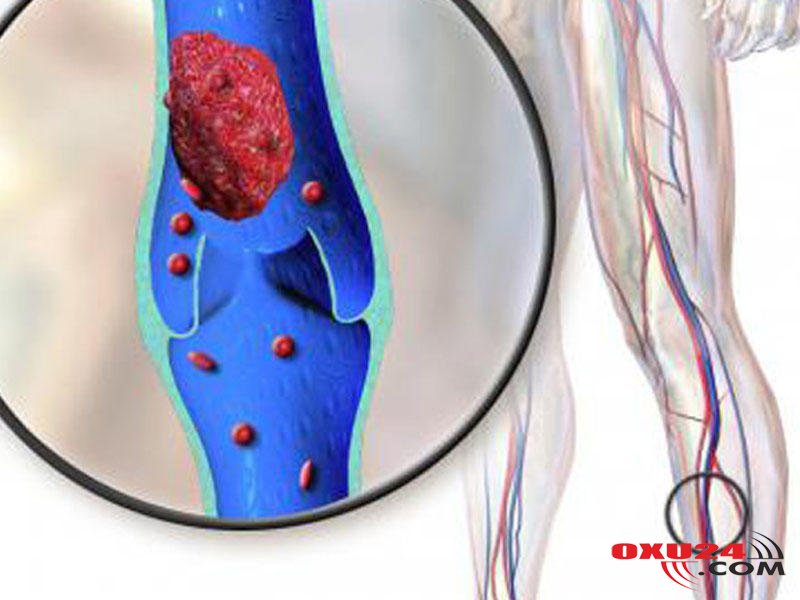 Damarda trombun olmasına işarə edən 8 əlamət
