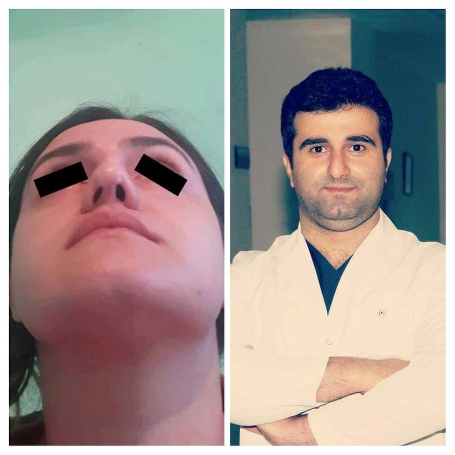 Məşhur estetik cərrah gənc qızın burnunu pis hala saldı- FOTO