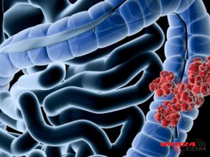 Bağırsaq xərçəngindən qoruyan qidalar – SİYAHI