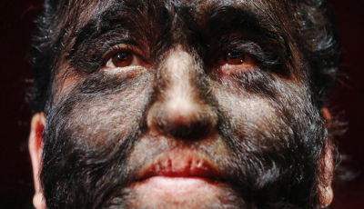 Tüklənmə xəstəliyinin təhlükəsi varmı?-Həkimdən vacib açıqlama