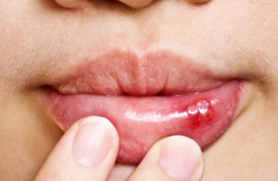 Ağızda  çıxan yaralar bu xəstəliklərin əlamətidir