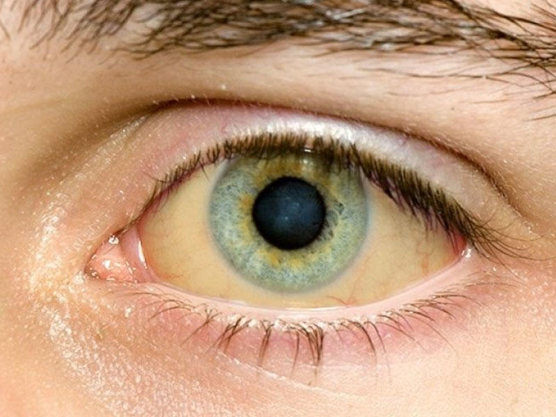 Gözlərinə bax, xəstəliyini tap - Təhlükəli dəyişikliklər