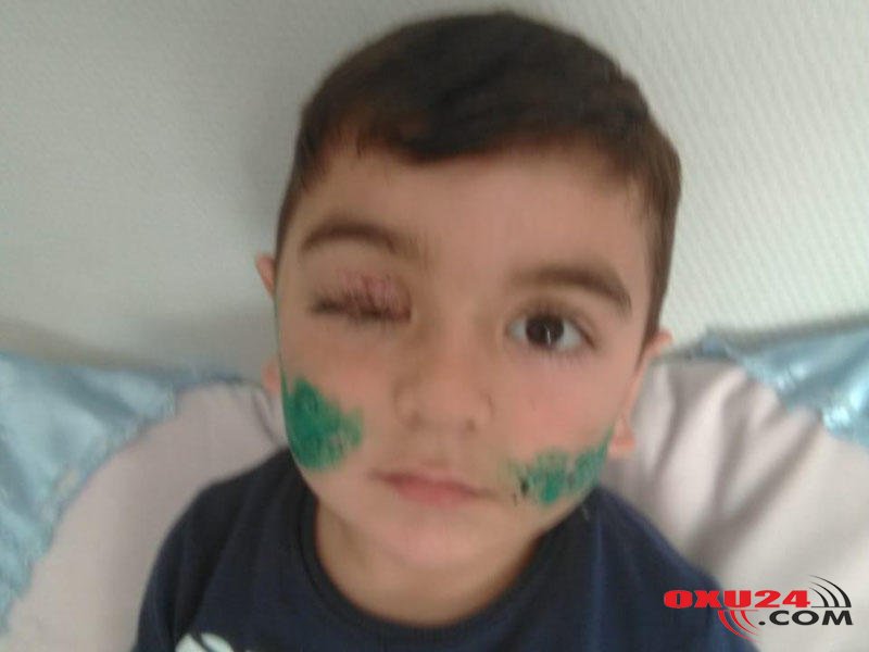 Üzünü it parçalayan uşağın SON DURUMU - FOTO