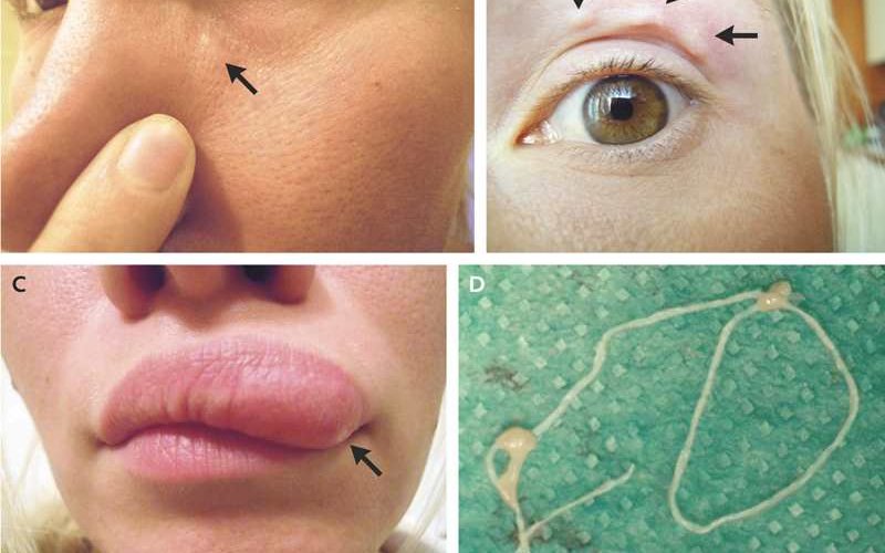 Qəfil ölümlərin səbəbi bu qurdlar imiş – Qadının üzündə yaranan şiş həkimləri dəhşətə gətirdi