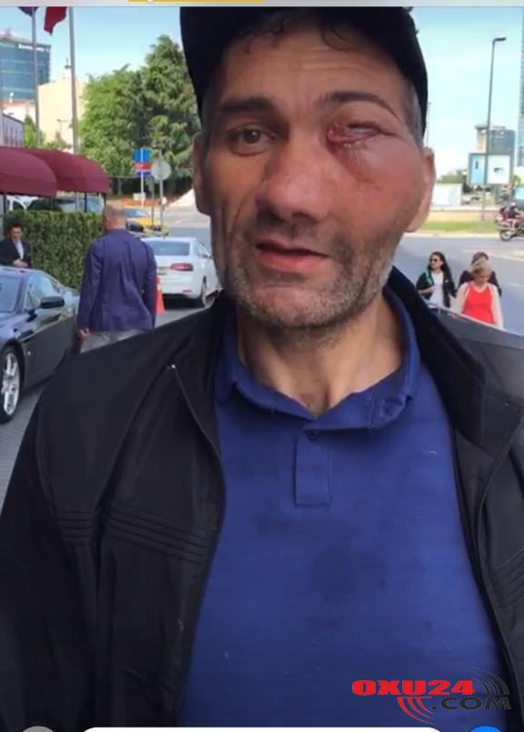 Üzündə nəhəng şiş yaranmış kişini Türkiyədə belə müalicə edirlər – Həkimindən Açıqlama