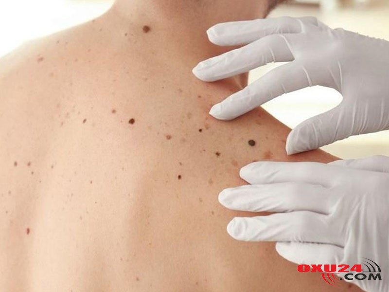 Bədəndə çox sayda xal olması nəyin əlamətidir - DİQQƏT