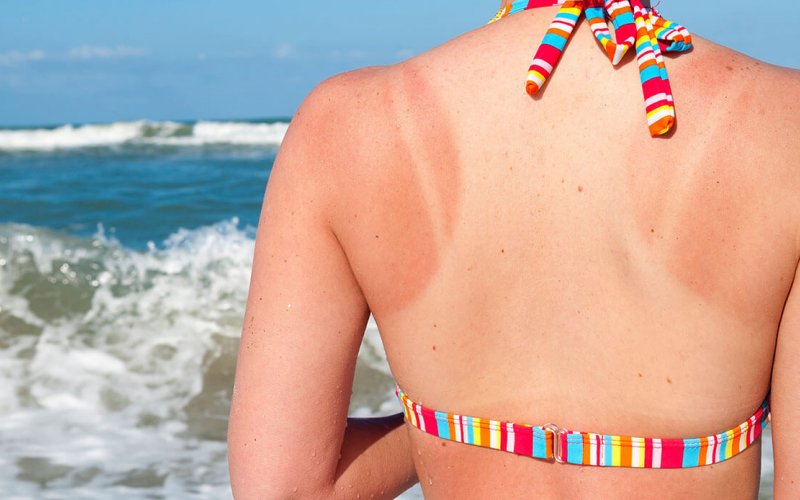 Günəş yanıqlarından qorunmağın effektiv üsulları – YAY FƏSLİNİN ƏN BÖYÜK DƏRDİ