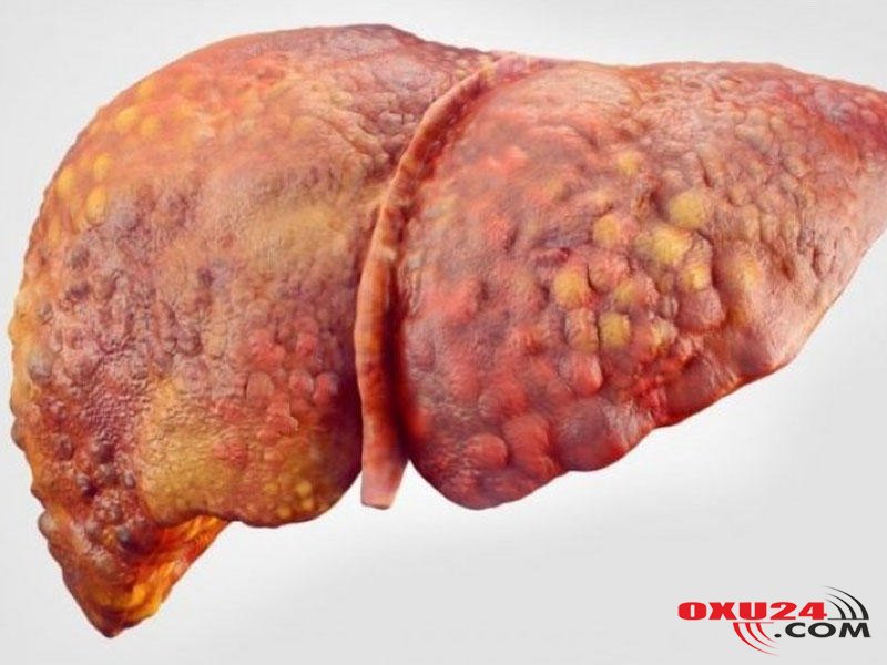 Sirrozu təkcə hepatit yaratmır, başqa səbəblər də çoxdur – Müayinə barədə həkim məsləhəti