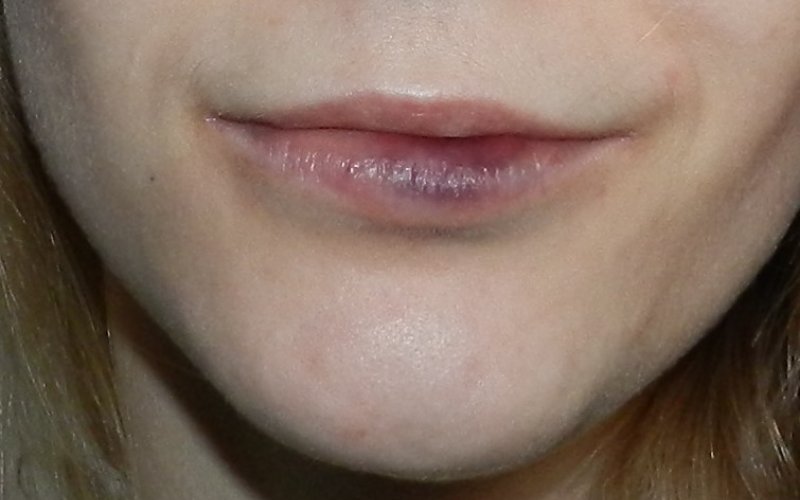 Göyərmiş dodaqlar hansı təhlükədən xəbər verir?- DƏHŞƏTLİ  XƏSTƏLİYİN ƏLAMƏTİ