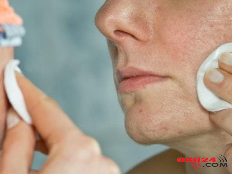 Sızanaqlardan xilas olmağın yolu - RESEPT