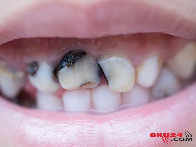 Bu qidalar dişləri MƏHV EDİR - Məşhur stomatoloqdan VACİB XƏBƏRDARLIQ