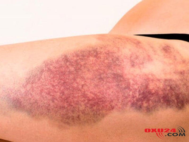 Hematoma və göyərmələrə qarşı effektiv vasitə - 1 günə aparır