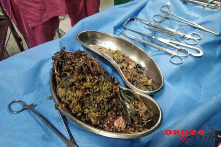 Görün qızın mədəsindən nələr çıxdı- Gözlərinizə inanmayacaqsınız !