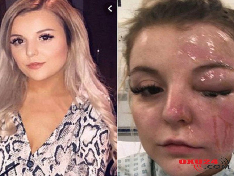 Yumurta qaynatmaq istədi gözünü itirdi