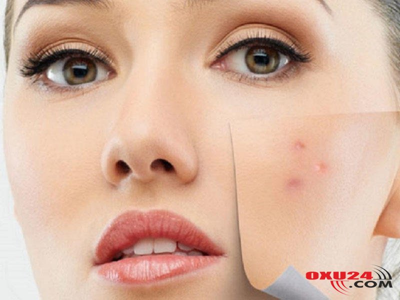 İltihablı sızanaqlardan qurtulmaq üçün maska