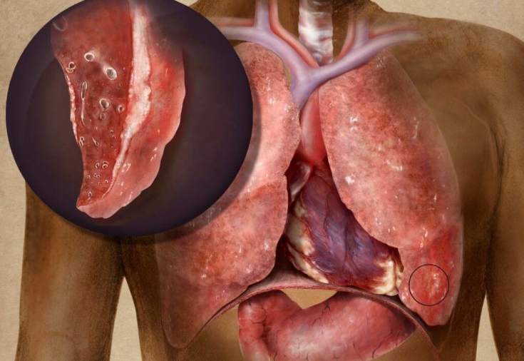 Vərəmin 6 əlaməti – Gecikməyin!