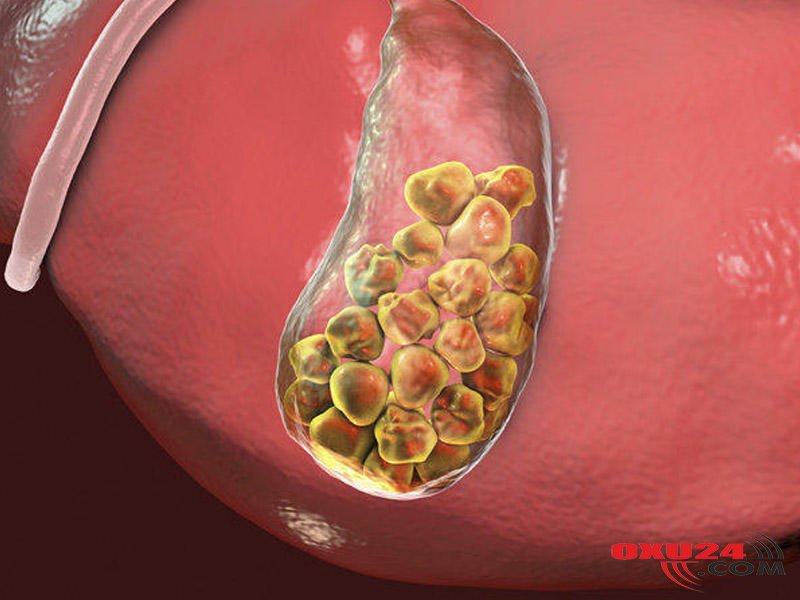 Yağdan imtina edən insanlarda öd daşı daha da çoxalıb, böyüyür – Rusiyanın tanınmış hepatoloqu