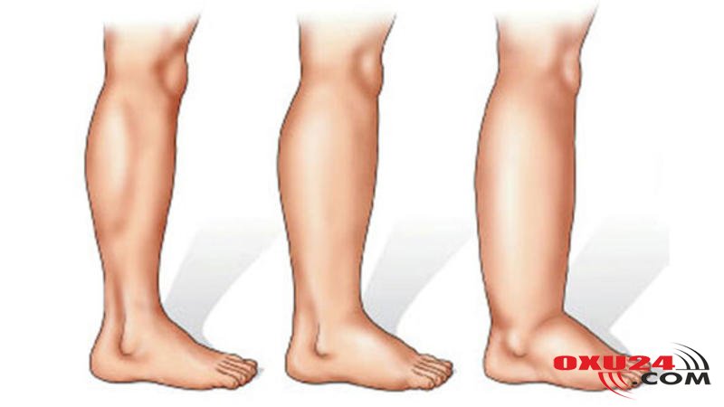 Ayaqların şişməsi hansı xəstəliyin əlamətidir? - Həkimdən XƏBƏRDARLIQ